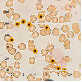 Marinesco Sigren syndrome