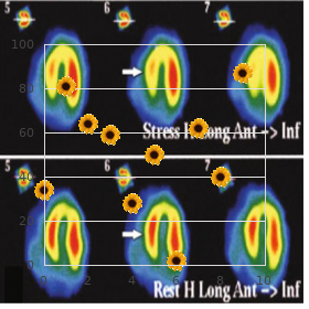 Wolcott Rallison syndrome