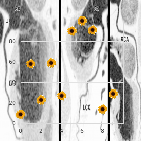 Alpha-L-iduronidase deficiency